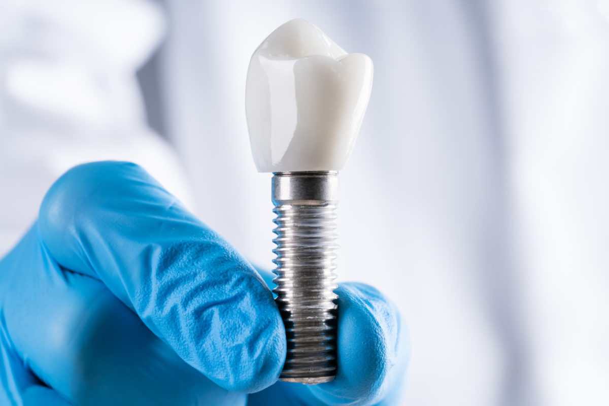 Implanty stomatologiczne Warszawa – jak działają implanty?